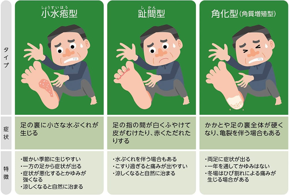 タイプ:小水疱型(しょうすいほうがた) 症状:足の裏に小さな水ぶくれが生じる。特徴:暖かい季節に生じやすい。一方の足から症状が出る。症状が悪化するとかゆみが強くなる。涼しくなると自然に治まる。 タイプ:趾間型(しかんがた) 症状:足の指の間が白くふやけて皮がむけたり、赤くただれたりする。特徴:水ぶくれを伴う場合もある。こすり過ぎると痛みが出やすい。涼しくなると自然に治まる。 タイプ:角化型(角質増殖型) 症状:かかとや足の裏全体が硬くなり、亀裂を伴う場合もある。特徴:両足に症状が出る。一年を通してかゆみはない。冬場は足のひび割れによる痛みが生じる場合がある。